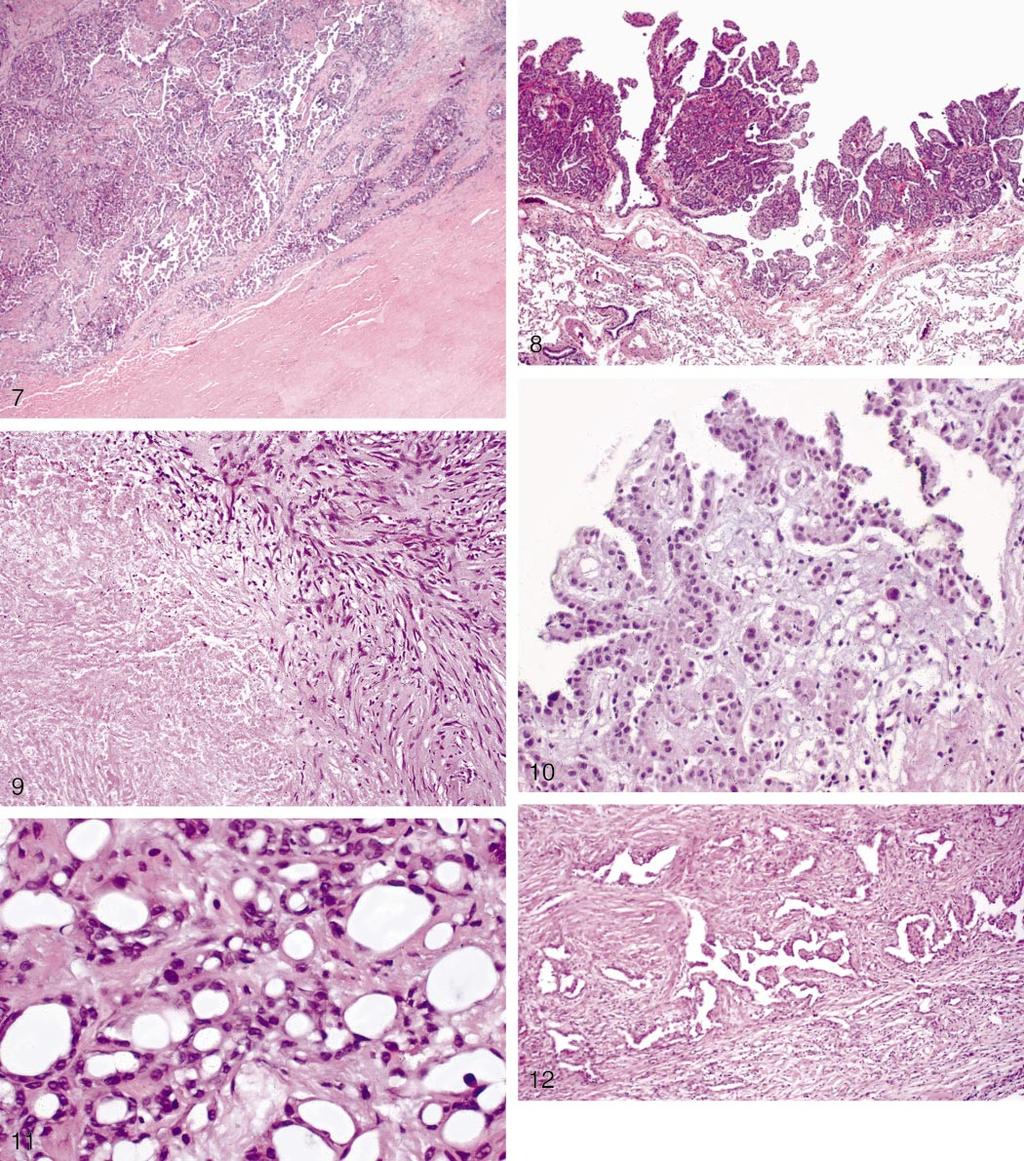 Figure 7. Bulk tumor on the pleural surface, as shown here, should be considered malignant (hematoxylin-eosin, original magnification 150). Figure 8.