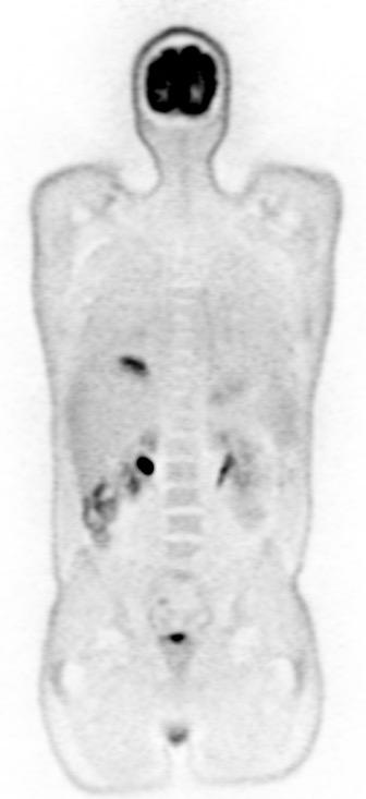 Case 4 CT PET with CTAC PET NAC PET with CTAC TOF Cause: Respiratory motion Misregistration of PET and CT at the