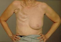 mastectomy) Convert inoperable to operable Convert
