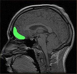 Orbitofrontal cortex From Wikipedia, the free encyclopedia Approximate location of the OFC shown on a sagittal MRI Orbital surface of left frontal lobe.