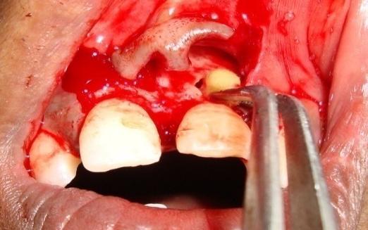 Surgical Procedure The full thickness mucoperiosteal flap was reflected at the site to restore the form and function of the tooth. The surgical procedure was carried out under local anesthesia.