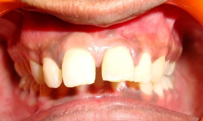Its clinical characteristics include gingival inflammation, periodontal pocket formation, loss of attachment and loss of alveolar bone around the affected tooth [8].
