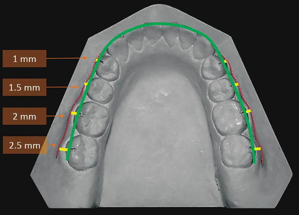 Distances between mandibular posterior teeth and the WALA ridge in Peruvians with normal occlusion points or other anatomic landmarks of the basal bone to predict the ideal dental arch form for a