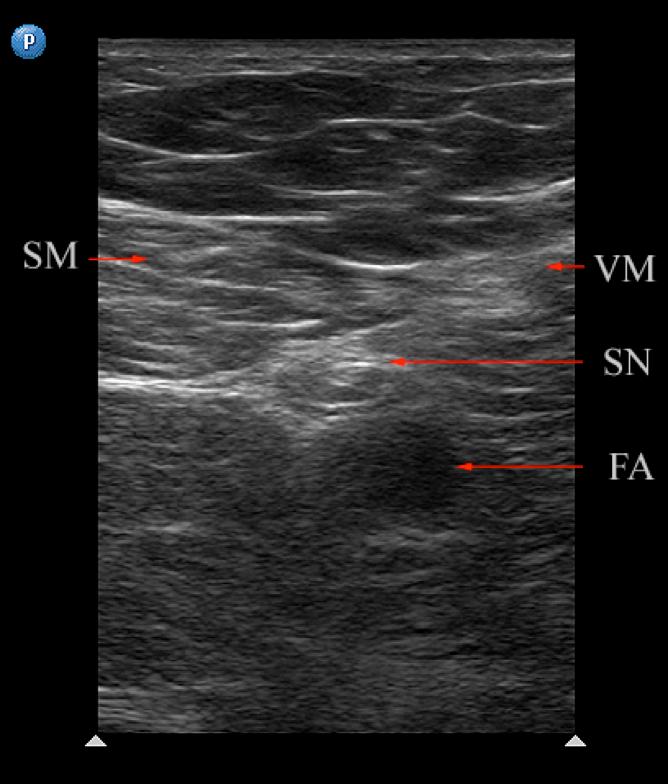 Locate the saphenous nerve in the adductor canal and follow it downwards