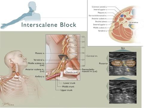 Interscalene Block 1. Identify carotid artery, internal jugular vein and vagus nerve 2. Locate the scalene muscles 3. Identify interscalene groove and brachial plexus (C5-C6 roots and C7) trunks 4.