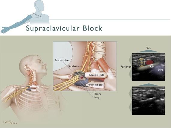Supraclavicular block 1. Identify subclavian artery 2. Look for first rib and pleura 3.