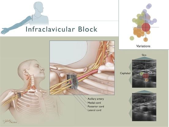 Infraclavicular Block 1. Identify the axillary artery and vein 2. Locate the pectoralis major and minor muscle 3. Identify pleura 4.
