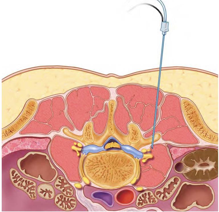locate the lumbar plexus and identify kidney laterally 3.