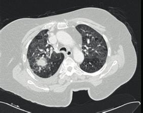 c) d) e) Figure 2 Chest CT on admission.