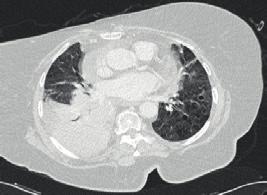 then a chest computed tomography (CT) were ordered