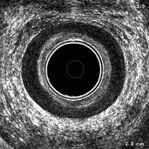 Additional Testing Endoanal ultrasound Anal manometry