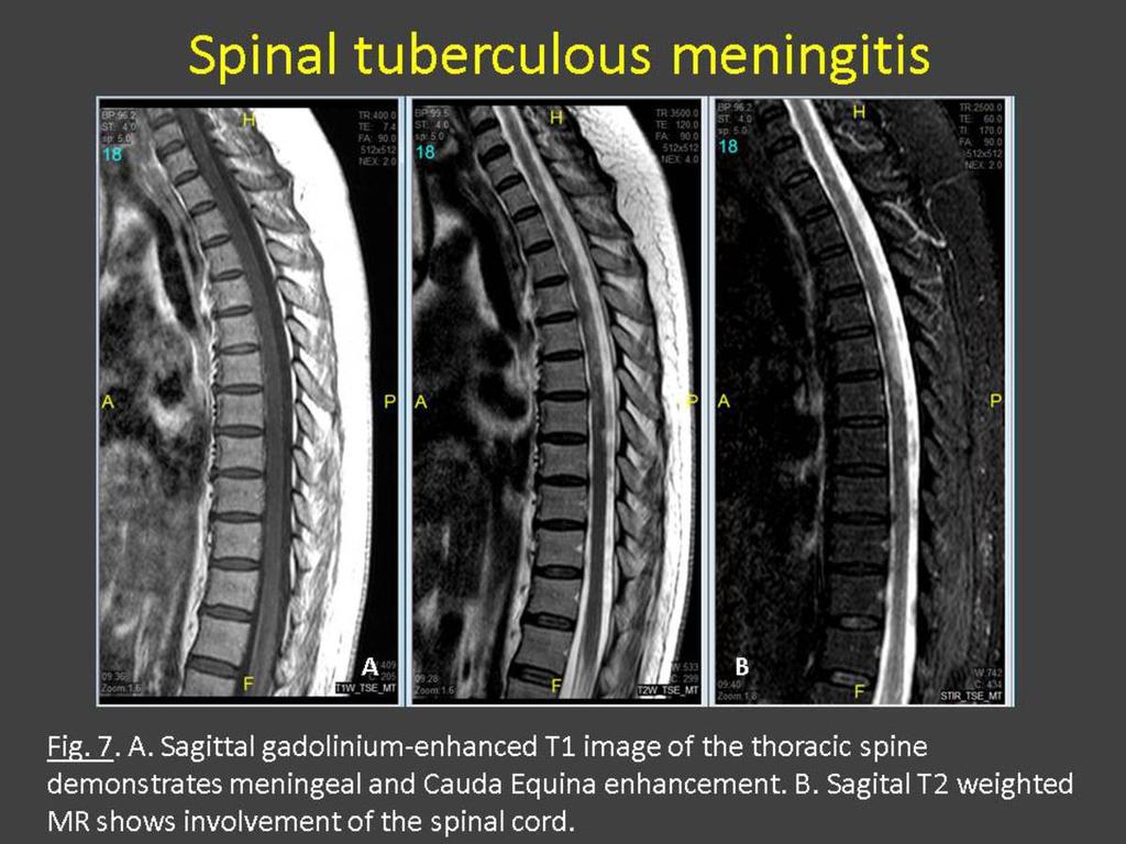 Fig. 7: Spinal