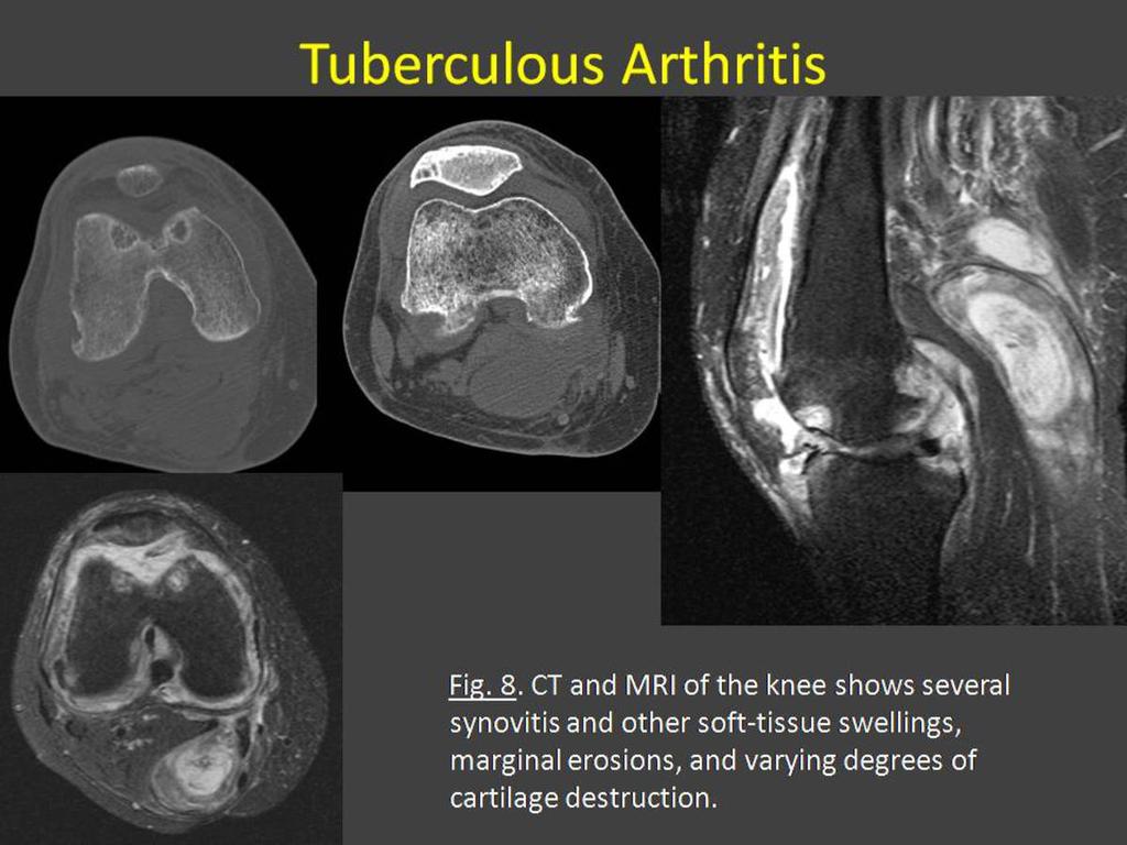 Fig. 8: Tuberculous