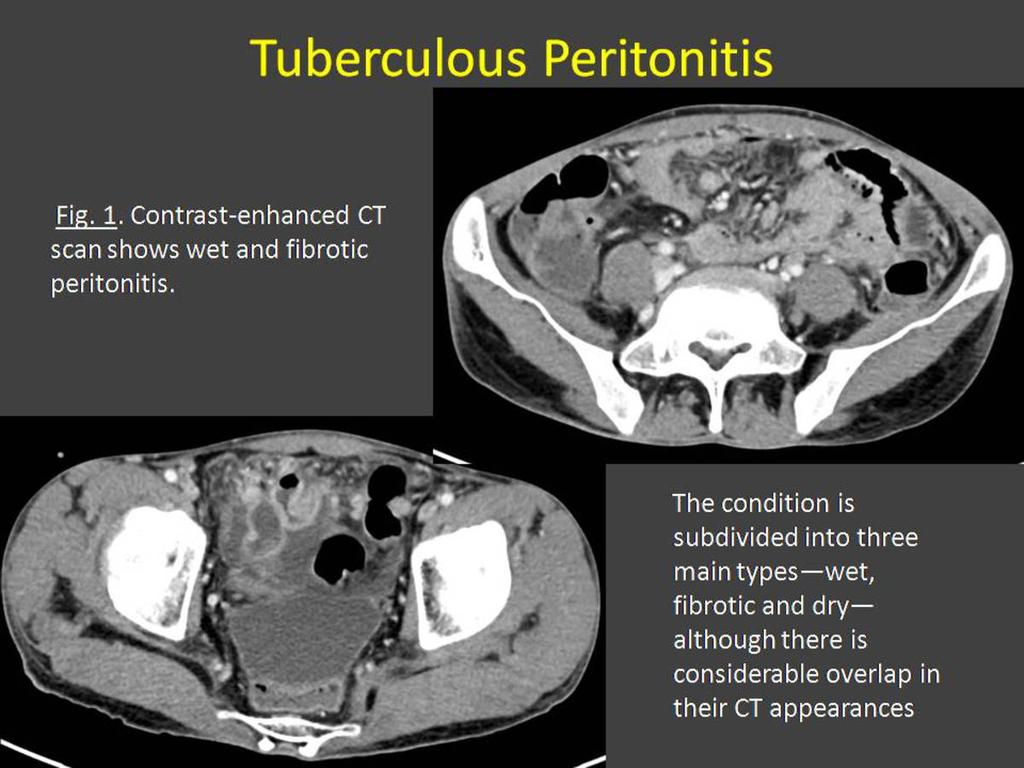 Fig. 1: Tuberculous