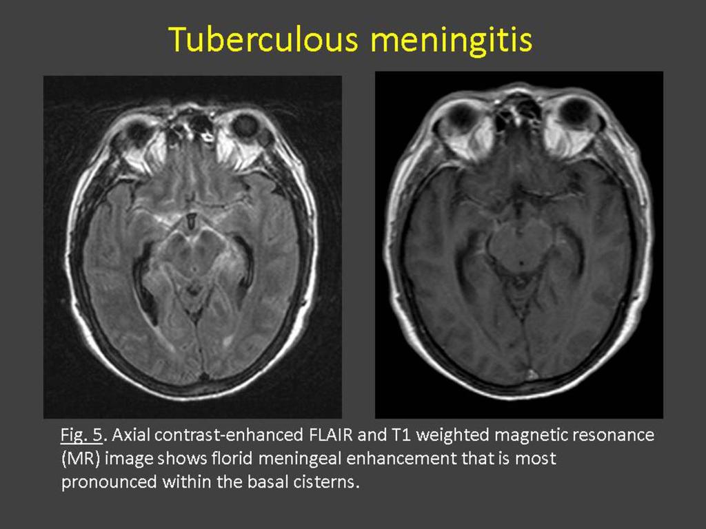 Fig. 5: Tuberculous