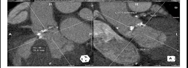 commissures Aortic annulus Sinotubular junction Allowed prediction of the risk of postoperative