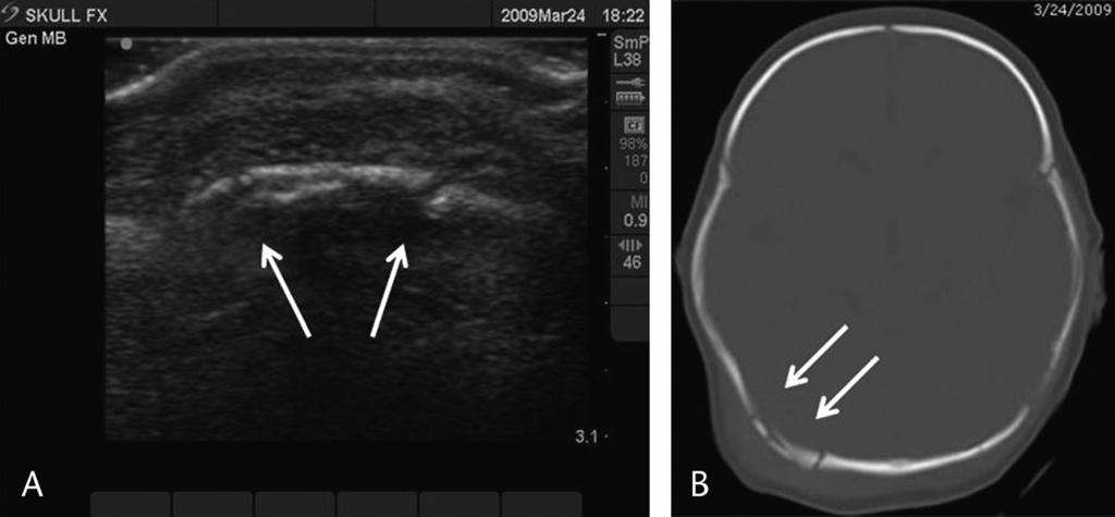 Riera and Chen Pediatric Emergency Care & Volume 28, Number 5, May 2012 FIGURE 1. A, Comminuted occipital skull fracture in a 2-month-old child as seen on bedside ultrasound.