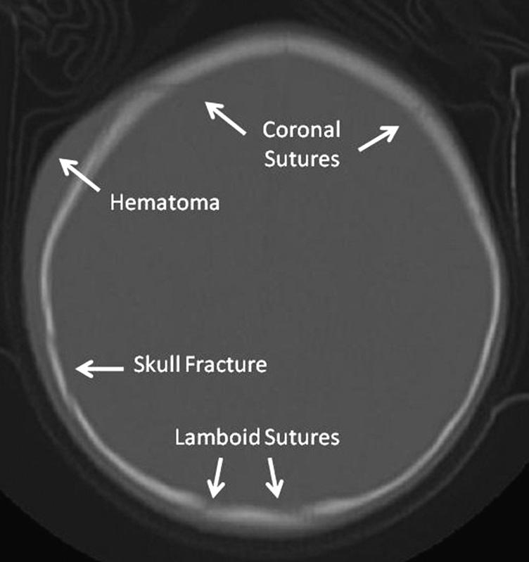Pediatric Emergency Care & Volume 28, Number 5, May 2012 Ultrasound Evaluation of Skull Fractures FIGURE 3. Nondisplaced linear skull fracture and parietal scalp hematoma in a 1-year-old child.