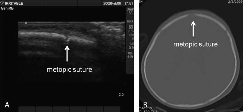 Riera and Chen Pediatric Emergency Care & Volume 28, Number 5, May 2012 FIGURE 5. A, Metopic suture observed on ultrasound and CT in a 4-month-old child with a small frontal scalp hematoma.