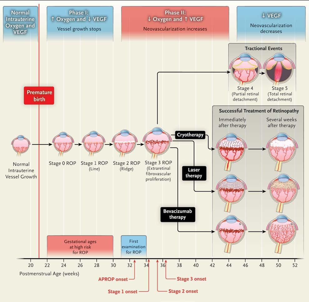 for Retinopathy of Prematurity Figure 1. Pathogenesis and Therapy of Retinopathy of Prematurity (ROP).