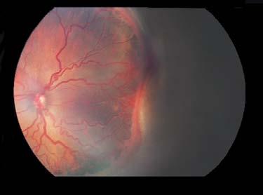 Panels A and B show the left retina of an infant before conventional laser therapy (at approximately 2 months of age, or 33.