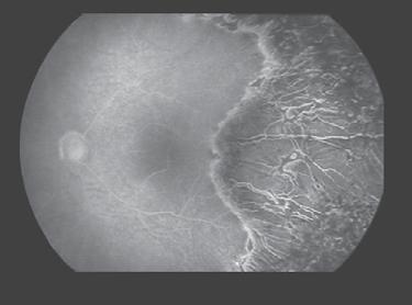 The post-treatment photograph shows destruction of the full thickness of the peripheral retina, with only choroidal vessels (not retinal vessels) visible in the lasered area.