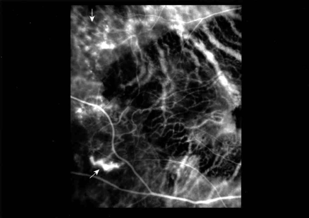 Fundus exmintion of the RE reveled n extensive geogrphi horoidl trophy in the mul tht hd ourred on the ground of n old srred CNV (Fig. 1).