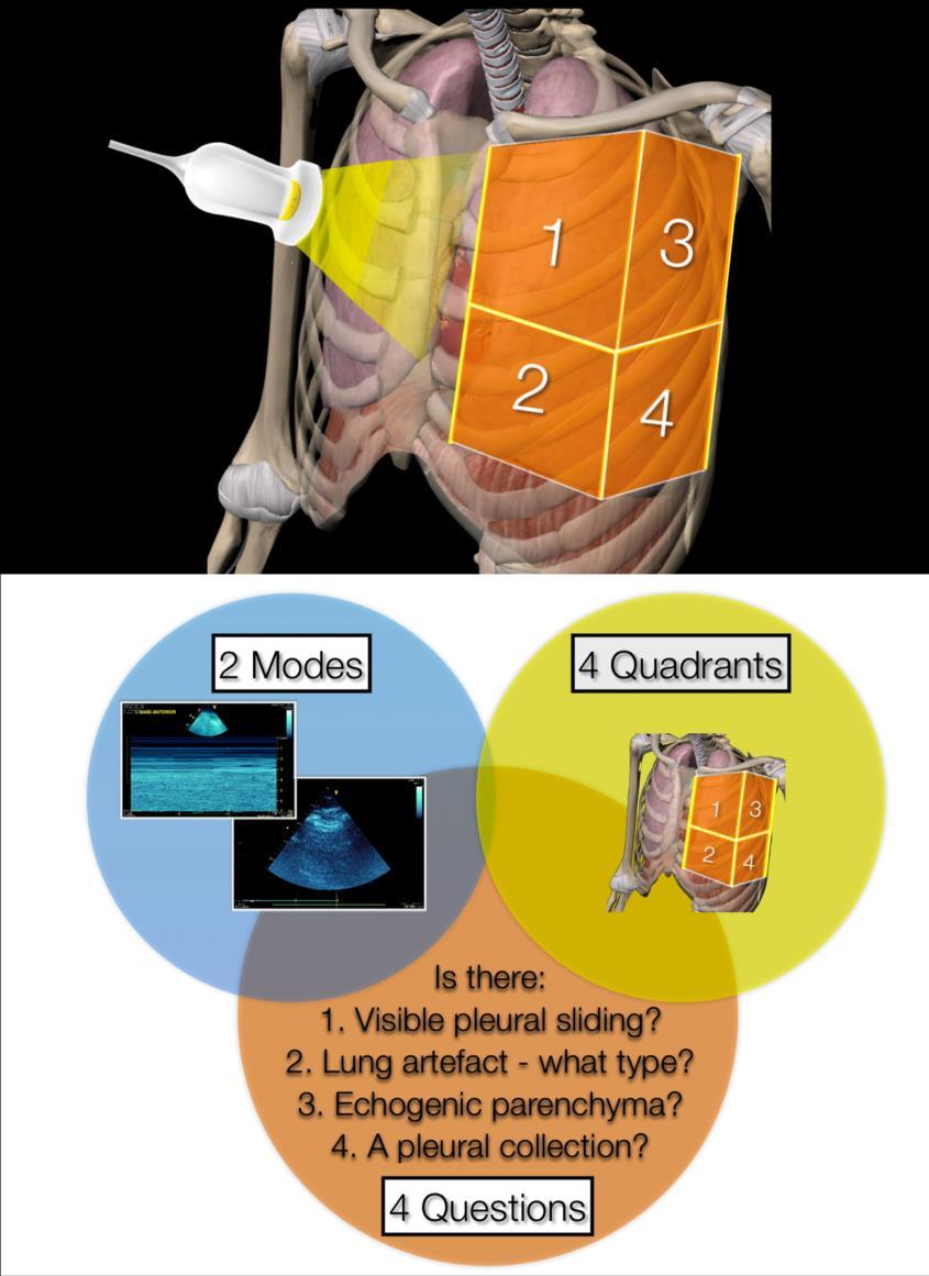 This appendix was part of the submitted manuscript and has been peer reviewed. It is posted as supplied by the authors. - Figure S1: The four quadrant approach lung ultrasound at the bedside.