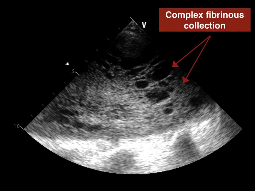 - Figure S10: Complicated effusions and empyema present as