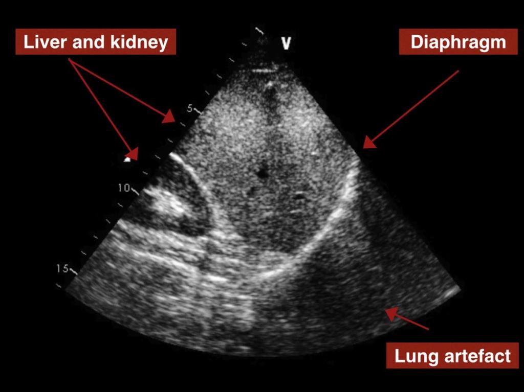 - Figure S3: To ensure anatomical orientation, the diaphragm should be identified as a bright
