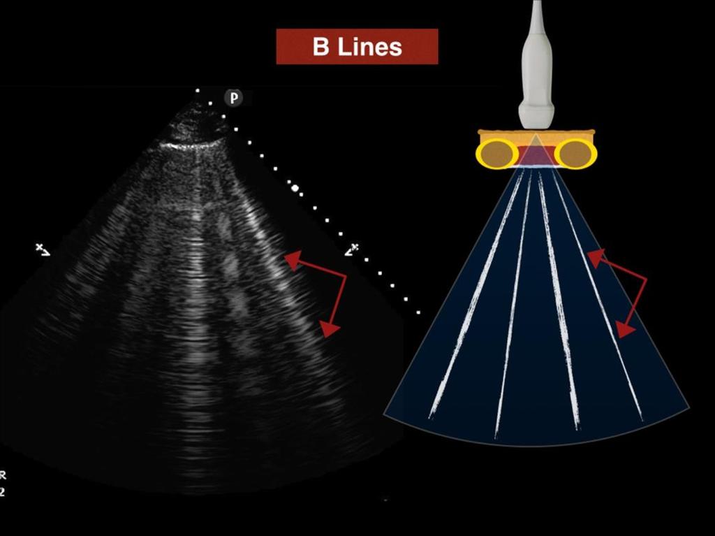 Figure S5: B-lines commonly represent an increase in interstitial fluid content.