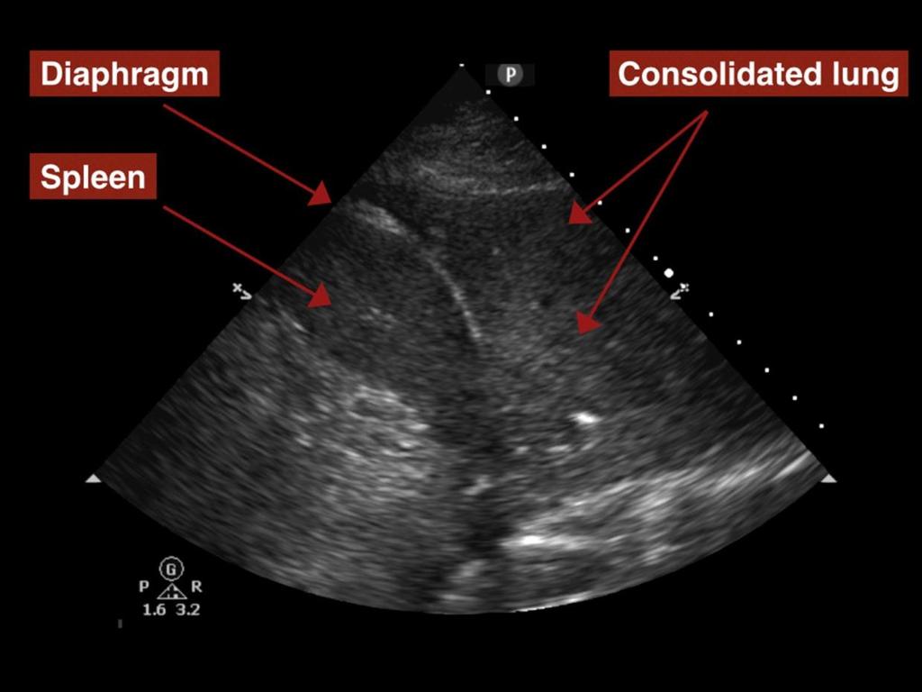 - Figure S6: Sonographic Hepatisation - collapsed or consolidated lung