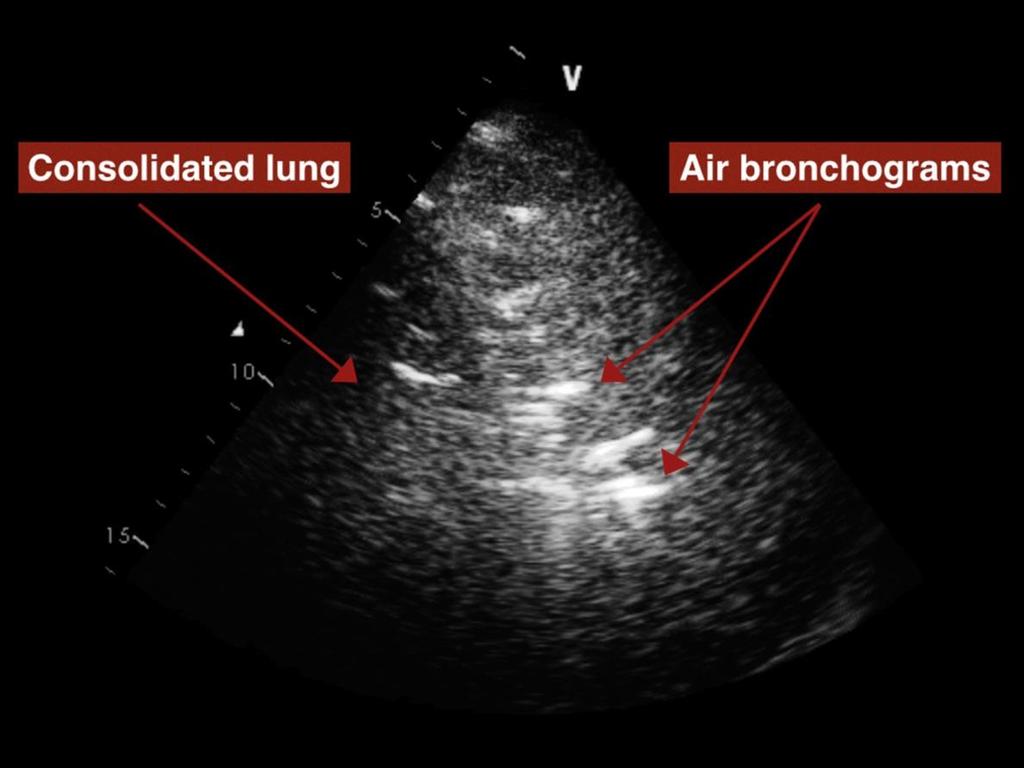 Figure S7: Pathognomic of consolidation, Air Bronchograms are bright