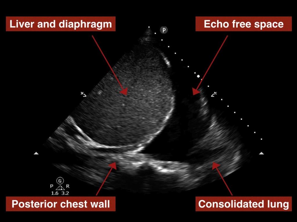 - Figure S8: Effusions are defined as a relatively echo-free space within