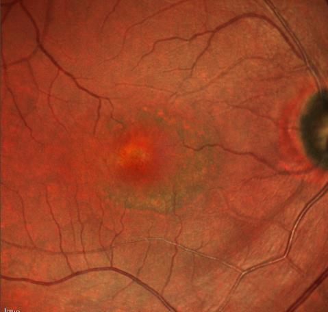 toxicity issues causing blindness Cumulative effect based on lifetime dose