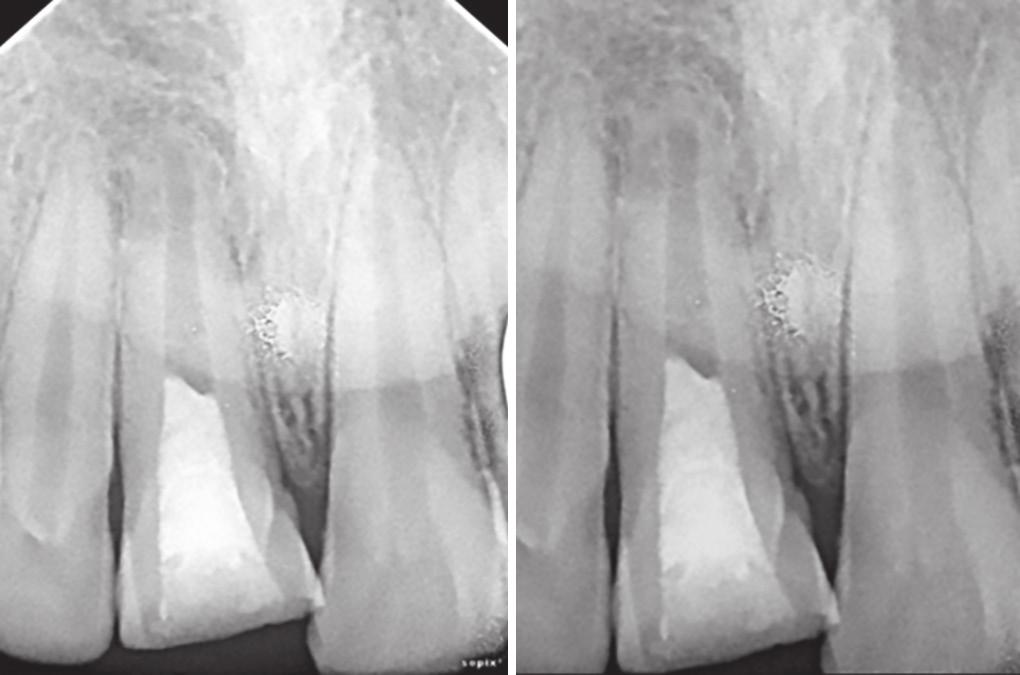 9 However, this study needs further one year to demonstrate progress in pulp revascularization and to check the responses of the teeth to