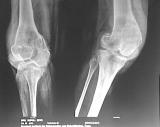 plate Radiographs showing GCT lower end femur with a pathological supracindylar fracture Immediate post op radiograph At 12 months follow up CASE 2: Excision and curettage and Reconstruction with