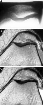 396 Boegård, Rudling, Petersson, et al Figure 2 (A) The axial radiogram of the left patellofemoral joint in a 58 year old woman with osteophytes of grade 1 at all joint margins.