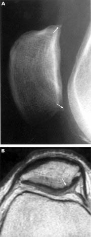 The corresponding axial (B) Pd and (C) T2 weighted MR images show a cartilage defect of grade 1 at the lateral facet of the femoral trochlea (arrow).