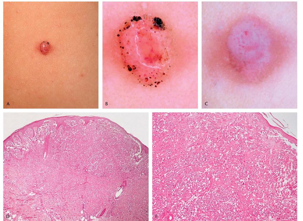 pink-red papulonodular lesions, previously considered classical Spitz nevus, could be histopathologically atypical with a great probability than tanblack macules & plaques of PSCSN/RN The previously
