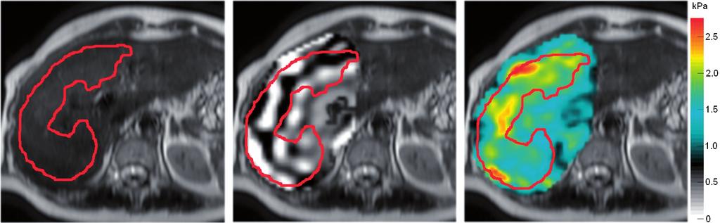 A B C Figure 1. Region of interest (ROI) placement in magnetic resonance elastography (MRE). (A) ROI placement on a magnitude image, avoiding liver margins and large vessels.
