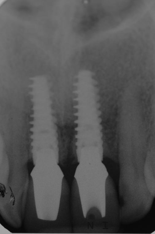Figure 13 Nobel Active Replicas As an immediate approach had been used for the 11 site it was difficult to place the implant for a palatal screw
