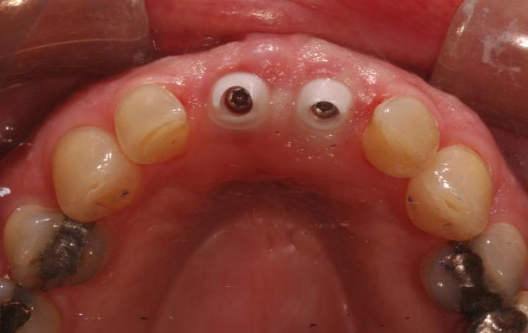 Figure 16 The access cavities were sealed with PTFE tape and the crowns cemented with Rely X resin modified glass ionomer cement.