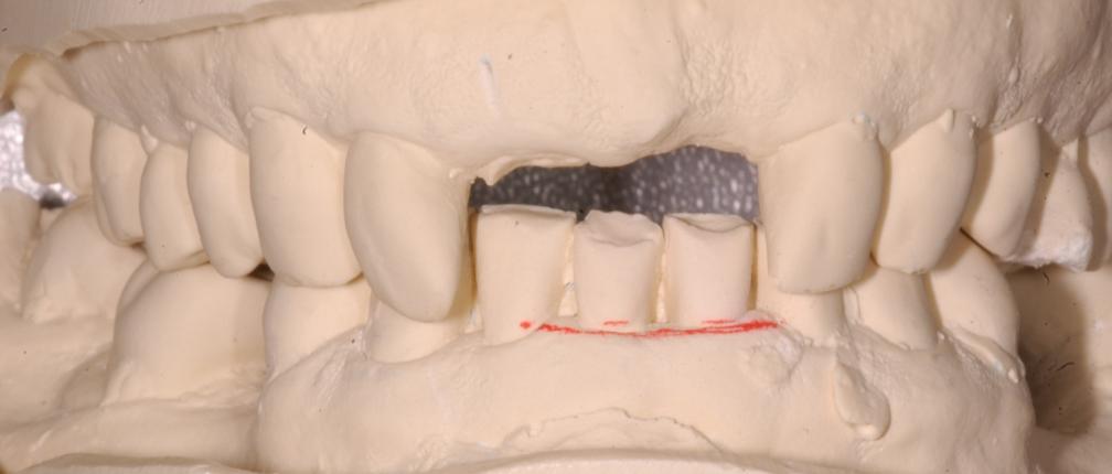 Figure 5 Mounted Study Casts Phase 2 Buccal flap reflected Extraction 11 root using