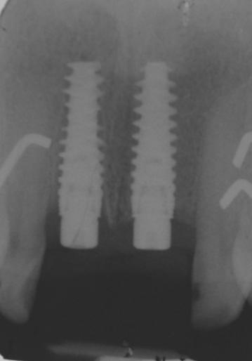 Figure 8 Post Implant Placement Phase 3 Five months post implant placement closed impression coping were used to