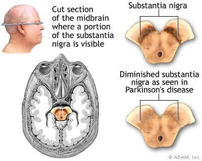 profiles PDD occurs in the setting of wellestablished parkinsonism (at least 1 year before onset of