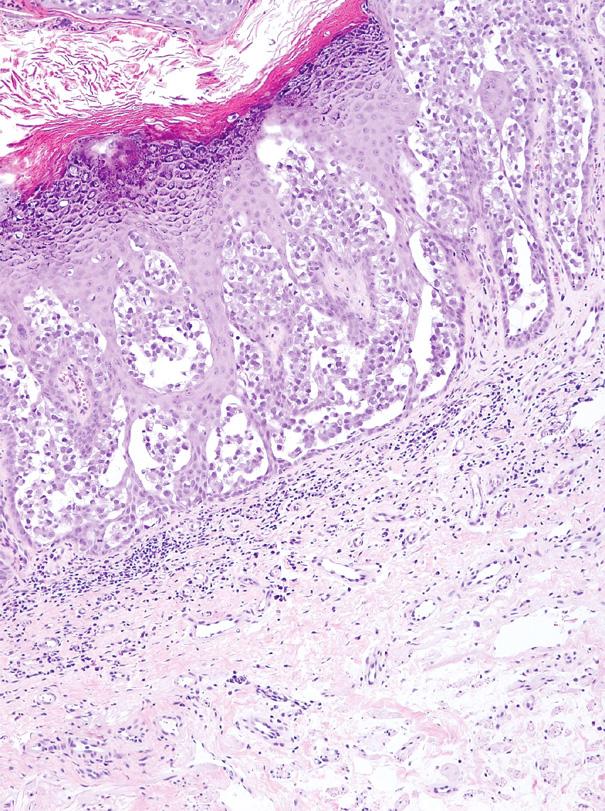 The atypical pleomorphic cells found in the spinous zone of different foci, in which a few cells had abundant, pale cytoplasm, were separated by clefts from the