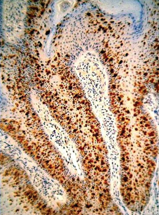 Immunohistochemical stains of the plaque lesion.