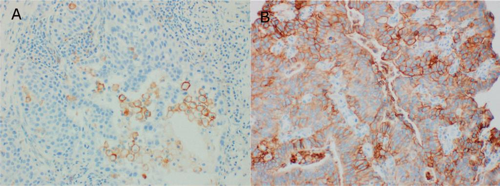 Figure 1. Gastric cancer specimens stained with PD-L1 immunohistochemical 22C3 pharmdx (Dako North America, Agilent Technologies, Carpinteria, California). A, Specimen with CPS, 1.
