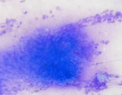 The authors suggested that early rapidly growing lesions, composed predominantly of basaloid cells, may lead to over diagnosis of malignancy 4.